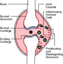 Inflamed Joint